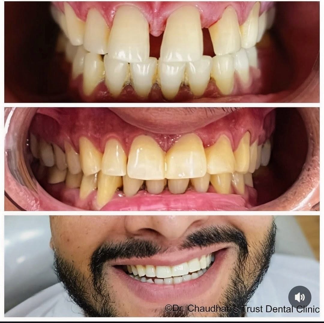 Smile transformation - Before and After dental treatment at Trust Dental Clinic