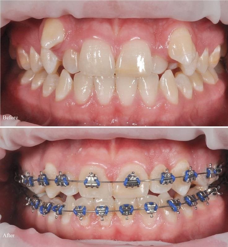 Orthodontic braces treatment - before and after